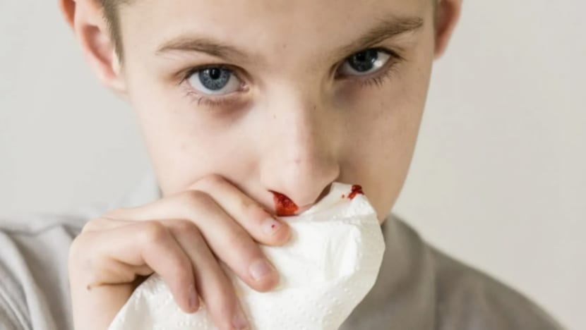 Cara atasi masalah hidung anak kerap berdarah Cara atasi masalah hidung anak kerap berdarah