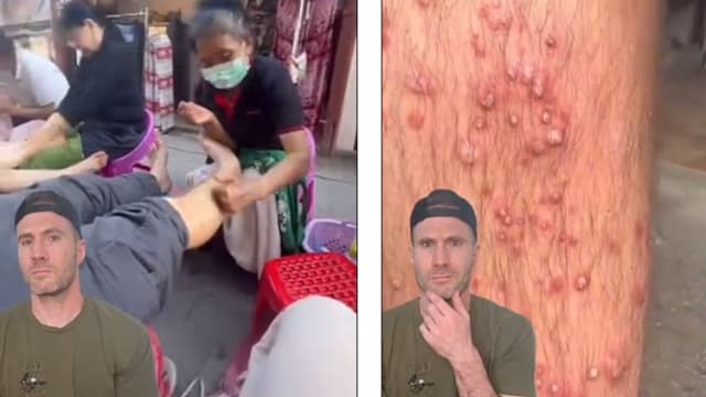 泰国街头花5元按摩 男子患毛囊炎双腿红肿化脓 
