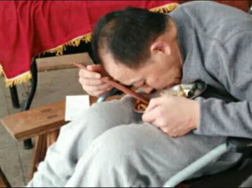Before the surgery, Mr Li Hua’s mother had to position a bowl for him to eat from.