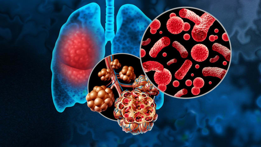 Kasus pneumonia Indonesia melonjak, apa pemicunya? Kasus pneumonia Indonesia melonjak, apa pemicunya?