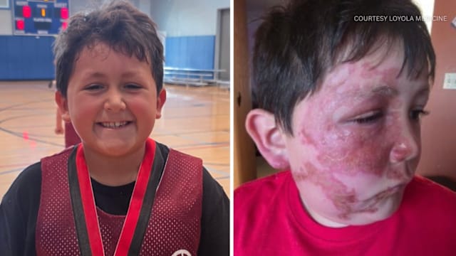 模仿朋友“加热玩具”社媒挑战 微波炉爆炸致男童灼伤