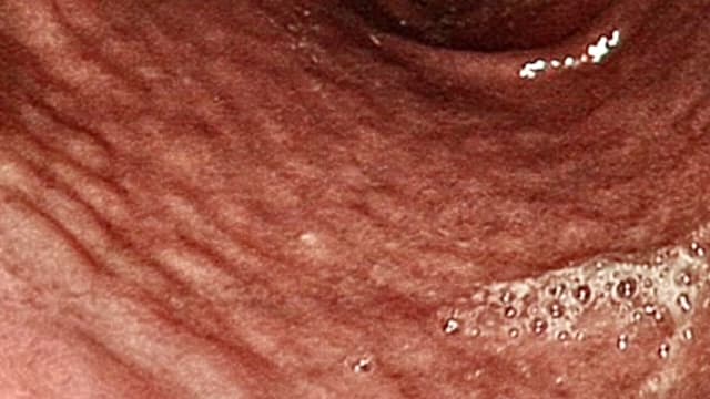 台湾少年突吐血 胃镜惊见“满满鹅卵石”