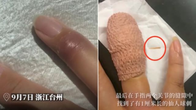 手指肿胀无法弯曲 中国女开刀挑出仙人掌刺