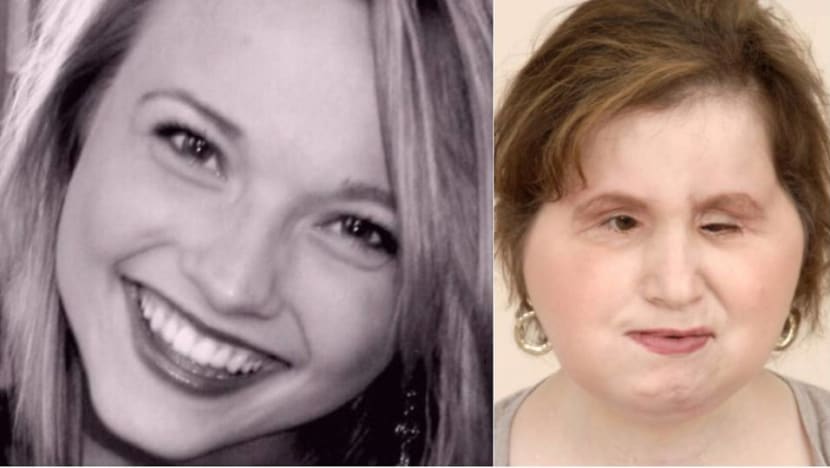 US woman who shot herself receives face transplant