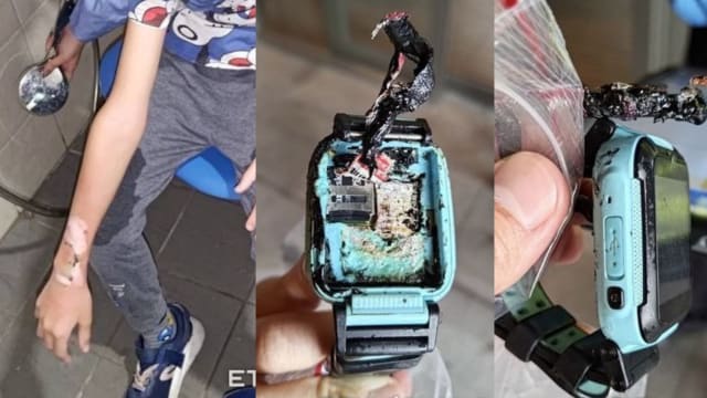 台湾男童智慧手表突爆炸 导致双手烧烫伤