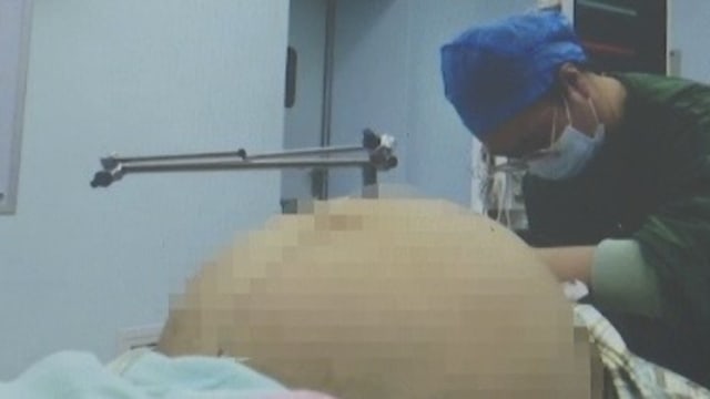 肚子大到如同怀双胞胎 中国女开刀取出21公斤肿瘤