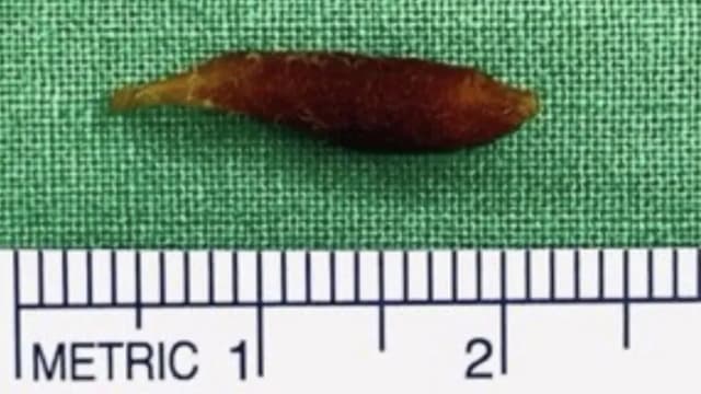 陈年棉花棒头藏耳内 台湾大叔面瘫狂流口水