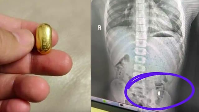 中国男童误吞10克金豆 母急提醒 ：别在外上厕所