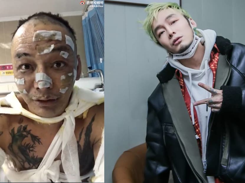 Chinese Rapper Suffers 2nd Degree Burns On 40% Of His Body After He Fell Asleep Without Putting Out A Scented Candle