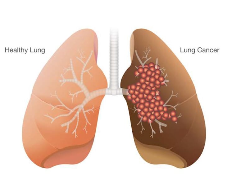 Study links genetic diversity of tumours with resistance to treatment in Asian lung cancer patients