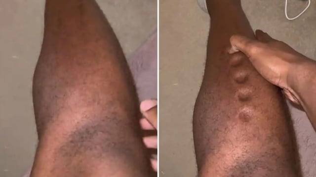 英国奥运运动员皮肤感染 小腿竟如同黏土按了就凹陷