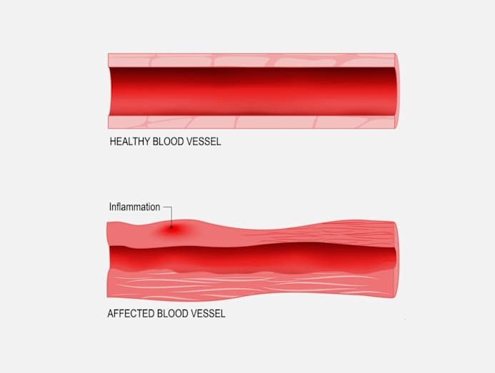 shingles-vaccine-heart-attack-stroke-benefit-3a.jpg
