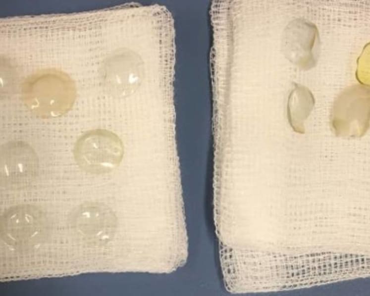 Cases of contact lenses stuck in eyes not that uncommon in Singapore, specialists say