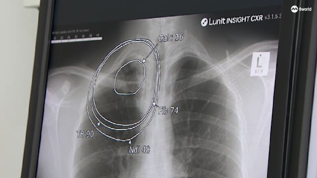 从两天到两分钟 AI加速结核病检测流程
