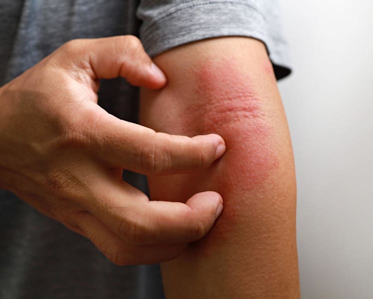 There’s a new eczema pill that offers quick and lasting relief – here’s what you need to know