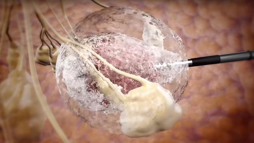 Freezing away breast cancer: Treatment helps women keep breast intact in early-stage cases