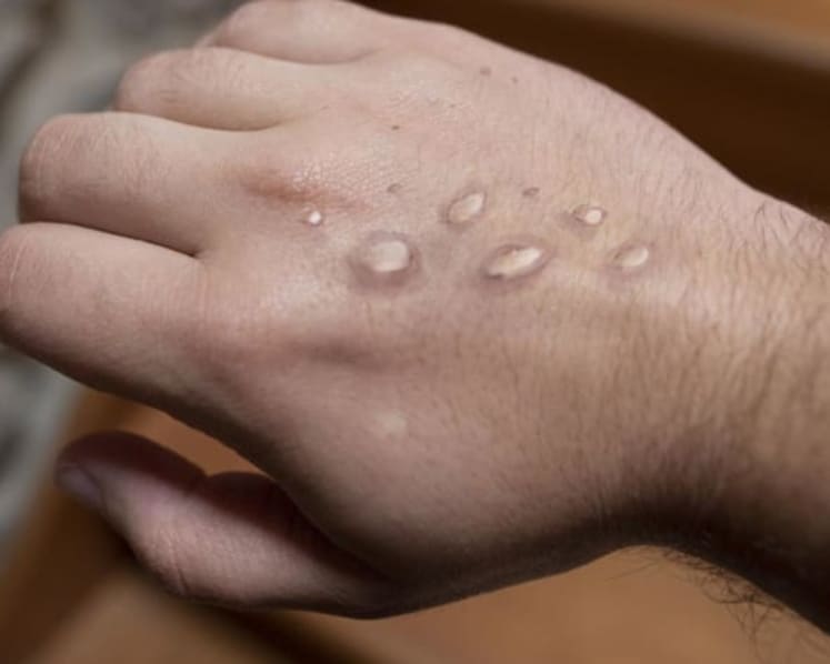 MOH confirms second local case of monkeypox infection in Singapore