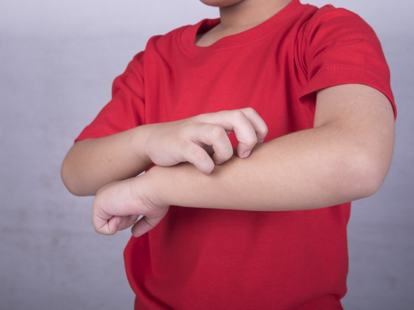 Scratching below the surface of eczema reveals it is a chronic condition that is more than skin deep. There is no cure for eczema, but maintenance treatments of daily moisturising can keep it under control. Photo: iStock