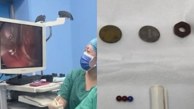 中国幼婴吞下硬币 随后吐出泡沫状痰液