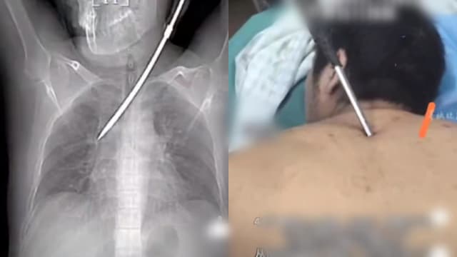 30公分螺丝刀高空坠落 直插中国男子胸腔