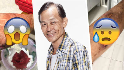 128 Circle Actor Duan Weiming Chose Spirit Medium Over Surgery To Treat His Injured Leg In Chainsaw Accident: “Luckily Successful!”