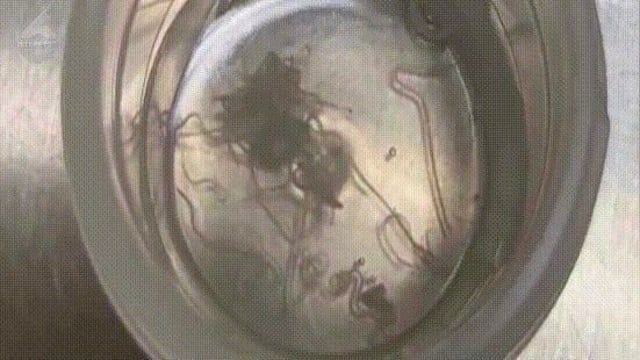 中国女子揉眼竟掉出寄生虫 医生取出60多条
