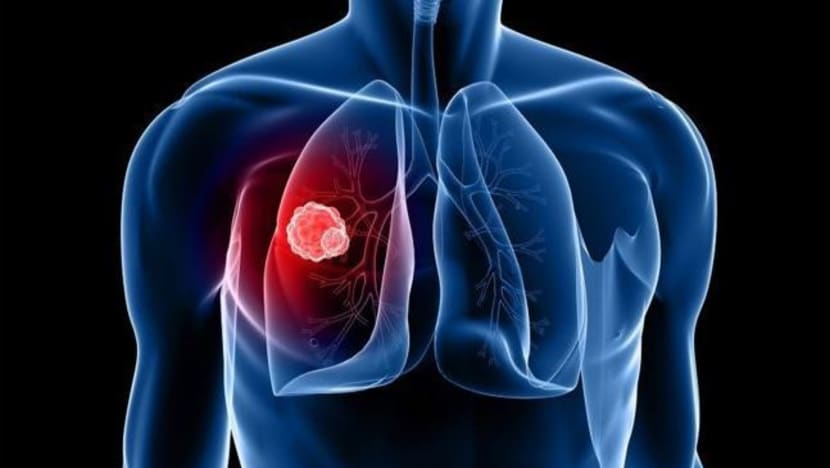 Lung cancer doesn’t only affect men or heavy smokers
