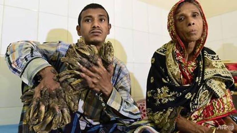 ‘Lelaki Pokok’ masuk semula hospital; keadaan bertambah buruk