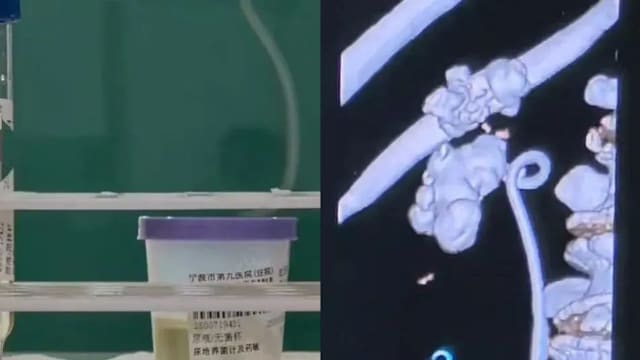 宁波男子乱服抗生素长达10年  “养”出超级耐药菌