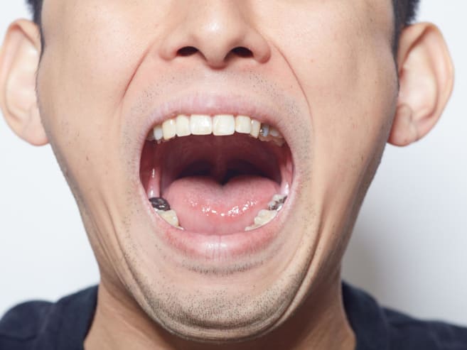 You could start losing teeth in your 30s – how to keep the rest of them before it’s too late