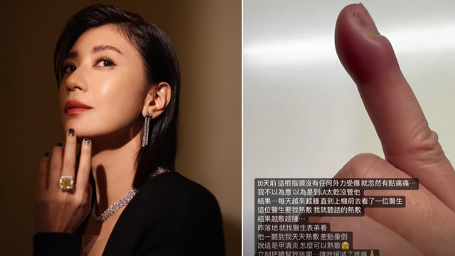 美国医生误诊　贾静雯手指越治越糟