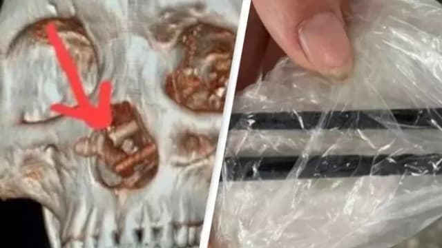 越南男子头痛五个月 就医发现头骨插筷子