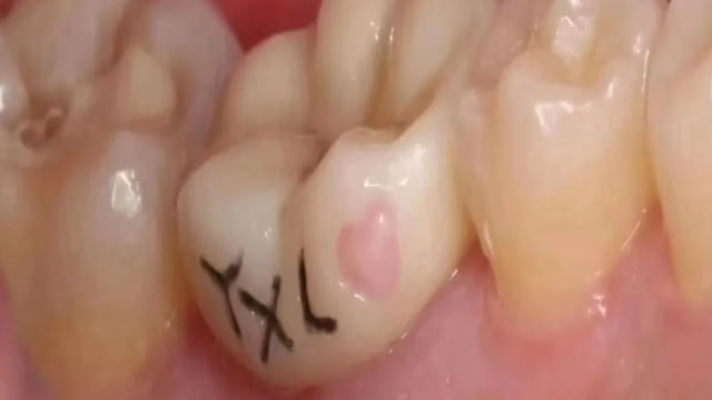 中国年轻人正流行 “牙齿文身” 医生提醒有风险