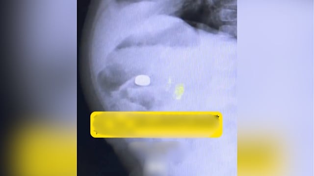 中国一岁男童误吞电池卡食道十小时 造成终身残疾