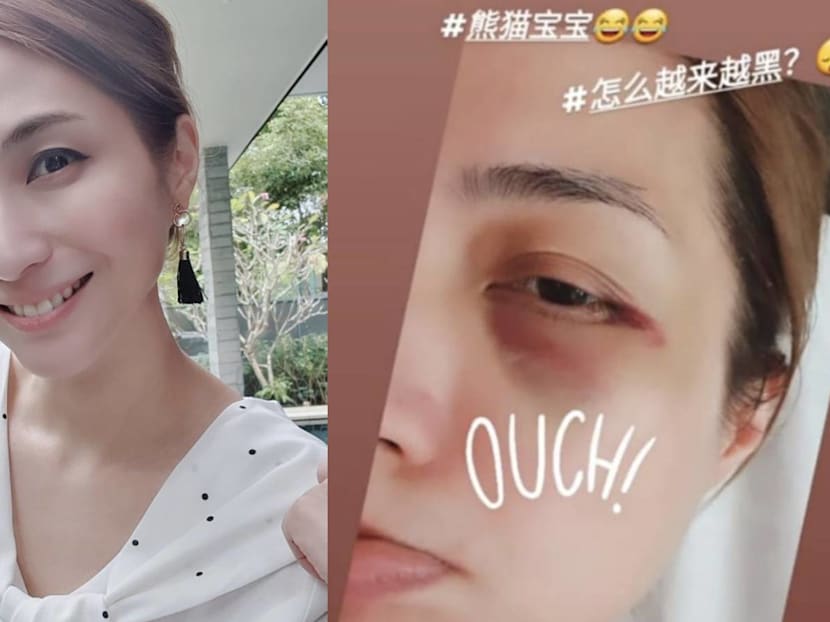 Vivian Lai Now Has A Bruised &ldquo;Panda Eye&rdquo; After Falling Down In The Middle Of The Night