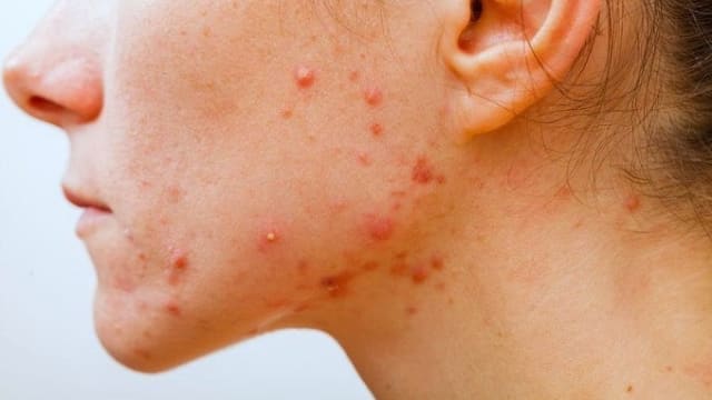 伤人颜面的成人痘　4个抗痘方法最有效