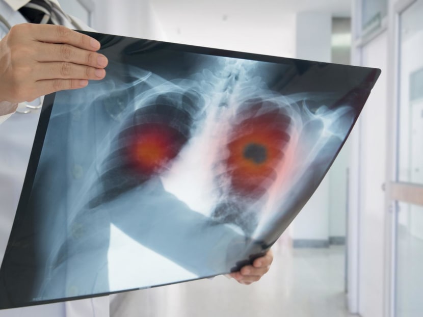 Free screening for smokers and high-risk individuals of lung cancer