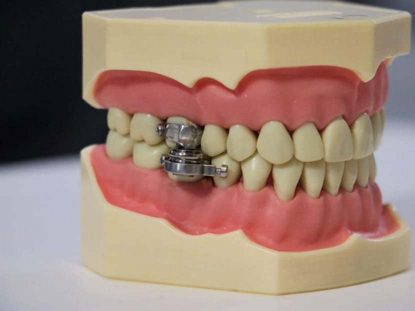 A weight-loss device created by New Zealand researchers that uses magnets to clamp a patient's jaw together — hailing it as a new tool against obesity despite critics likening it to an instrument of medieval torture.
