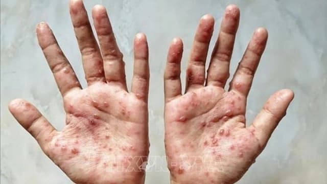 越南南部猴痘致八死 胡志明市占八成