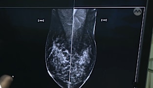மார்பகப் புற்றுநோயைக் கண்டறிய AI?