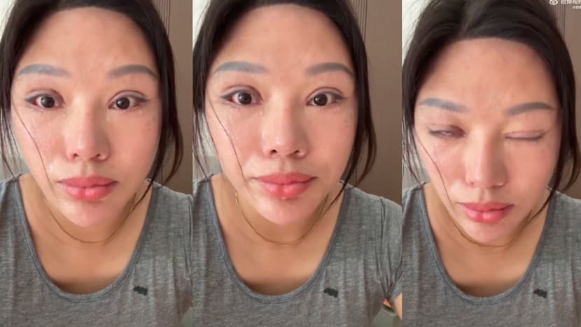 Woman Left Unable To Close Eyes After Botched Double Eyelid Surgery