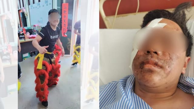 点烟火时意外爆炸 马国18岁舞狮团员右眼失明