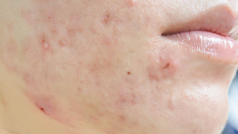 Acne in adults a pain to manage; experts zoom in to study Singapore’s cases