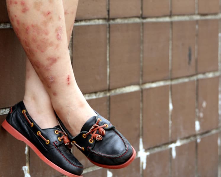 Tackling that itch: Demand for help with skin issues on the rise in Singapore