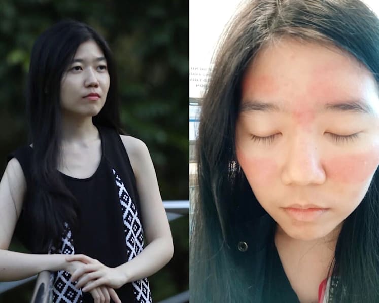 Gen Y Speaks: What dealing with my skin problems taught me