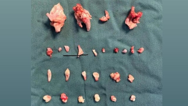 中国少女腹部长畸胎瘤 内含24颗牙与骨骼