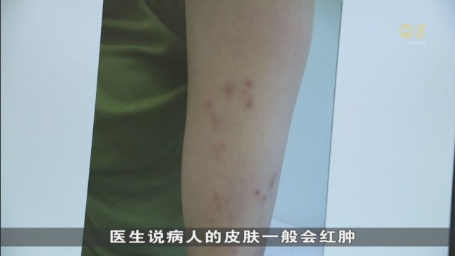 皮肤科诊所：近期更多人被臭虫叮咬求诊 增幅达15%