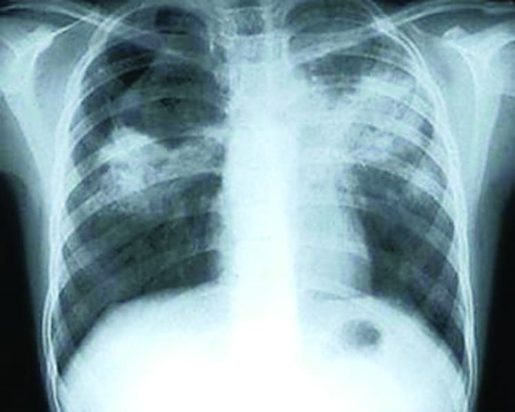 Drug-resistant TB ‘takes longer to cure, poses more risk’