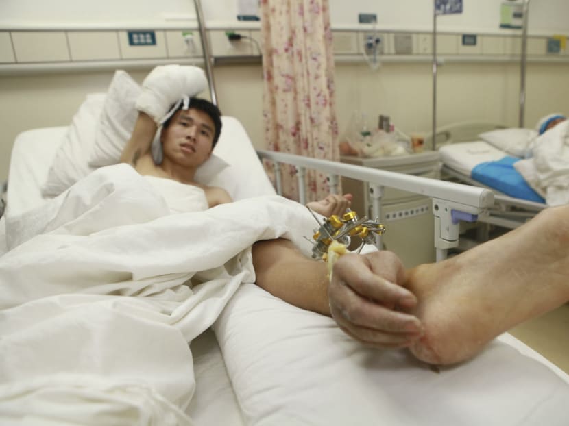 Severed hand stitched on man’s ankle to keep it alive