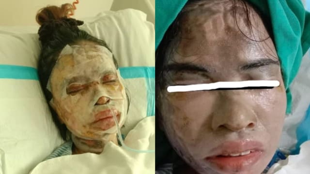 马国妙龄女子被泼硫酸 动手术八次换肤救眼